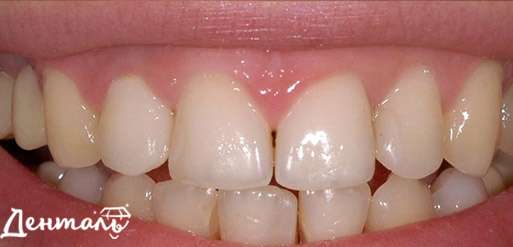 protezirovanie-zubov-do.jpg