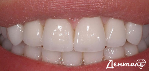 protezirovanie-zubov-posle.jpg